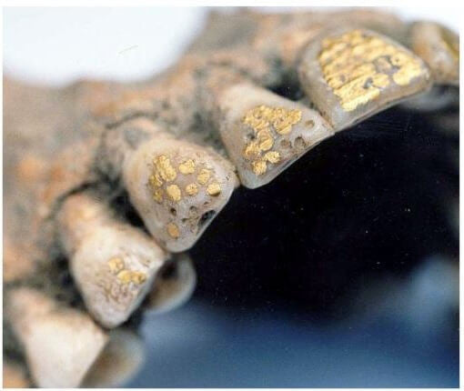 History of Gold Teeth and Gold Grillz